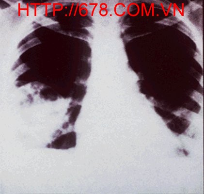 Bệnh nấm phổi Nocardia